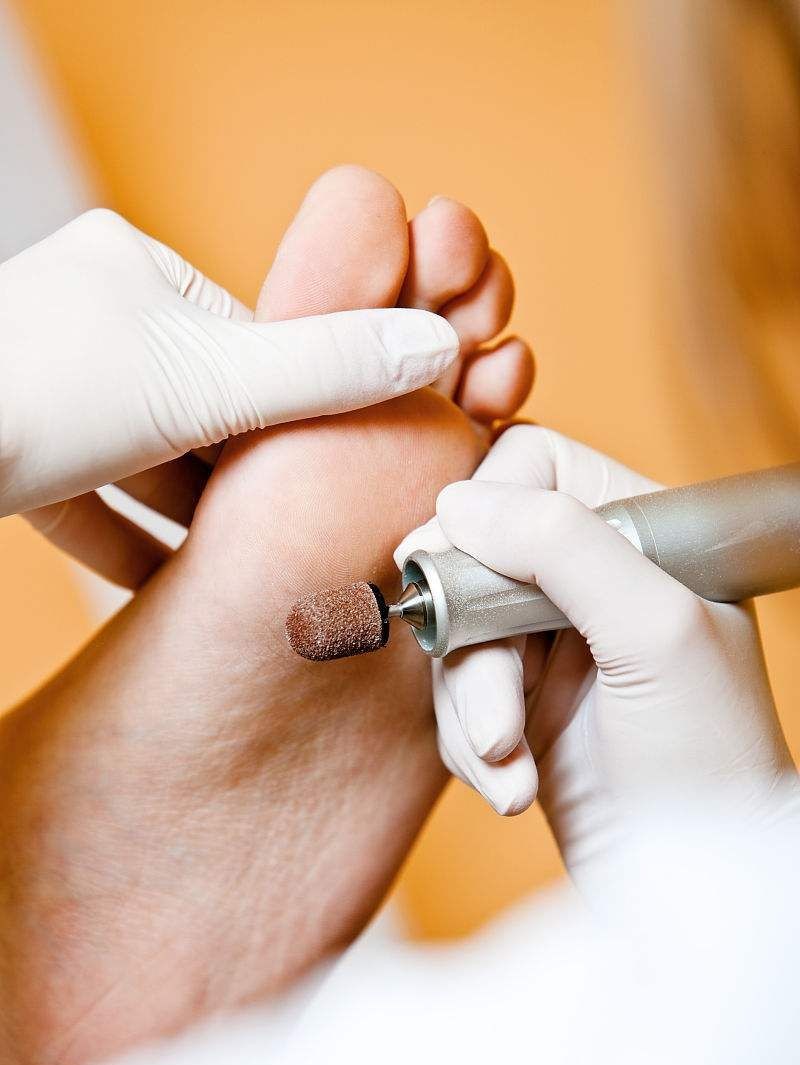 Tratamiento Pie Diabético en Pachuca - Podóloga Aurora Pachuca