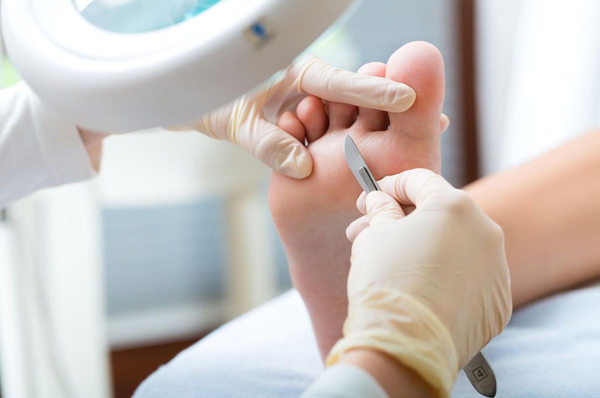 Tratamiento de Hongos y Callos en Pachuca - Podóloga Aurora Pachuca