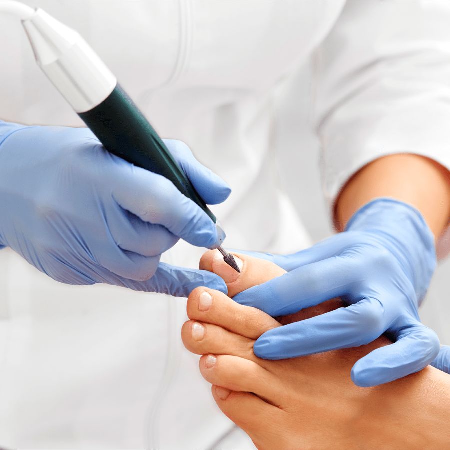 Tratamiento de Uña Encarnada en Pachuca - Podóloga Aurora Pachuca